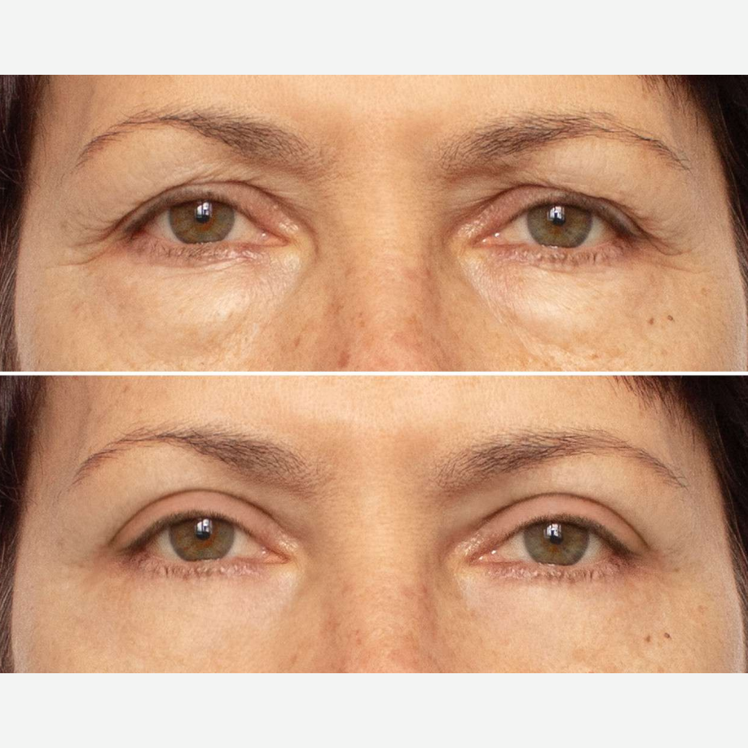 Patchs lissants aloe vera et collagène