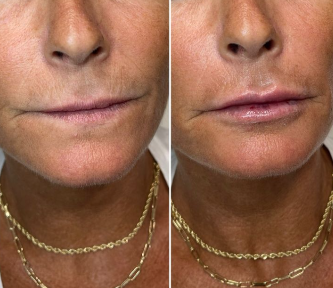 Gloss volume instantané